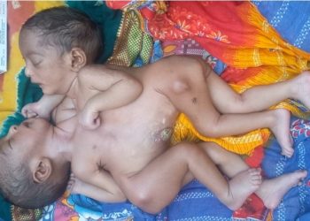 पेटदेखि छतीसम्म शरीर जोडिएकी बालिकाको ज्यान जोगाईदिन अपिल