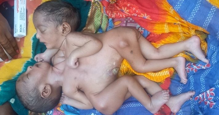 पेटदेखि छतीसम्म शरीर जोडिएकी बालिकाको ज्यान जोगाईदिन अपिल