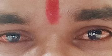 आँखा पाक्ने रोग लागिहाले के गर्ने ?